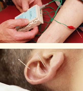 Acupuncture techniques